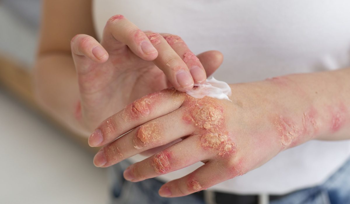 Ayurveda y psoriasis: curar la piel de forma natural desde dentro